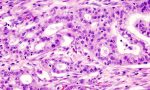 Tumore al pancreas: trovata la chiave per aprire la "porta" ai linfociti che eliminano i tessuti malati