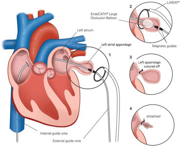 Operazione cuore