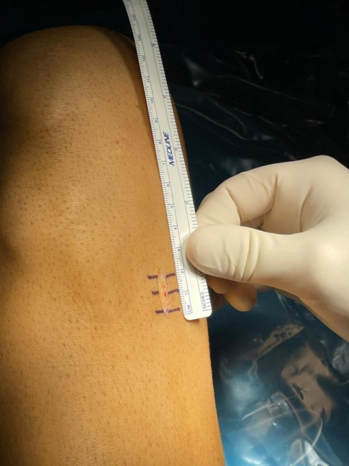 Eseguito il primo trapianto di tendine da donatore vivente da padre a figlio 14enne