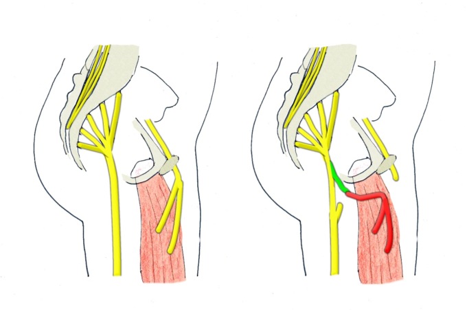 Bimbo di 2 anni sottoposto ad intervento pioneristico per ripristinare la funzione di un arto paralizzato dalla mielite flaccida acuta