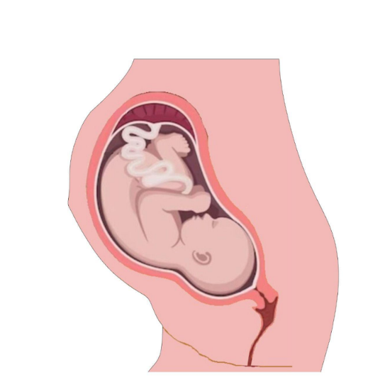 Gravidanza con l’utero in una grande ernia fuori dall’addome: salvate mamma e figlia con un complesso intervento