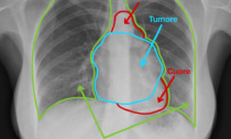 Salvata una donna con l'asportazione di un tumore timico di enormi dimensioni