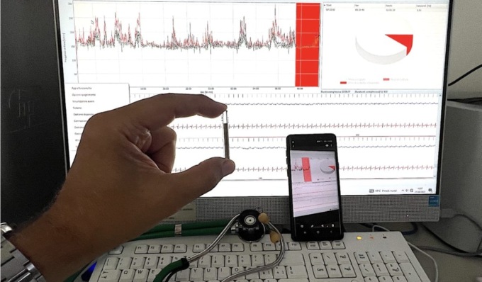 Continui arresti cardiaci, 13enne salvata grazie alla telemedicina con l’impianto di un pacemaker