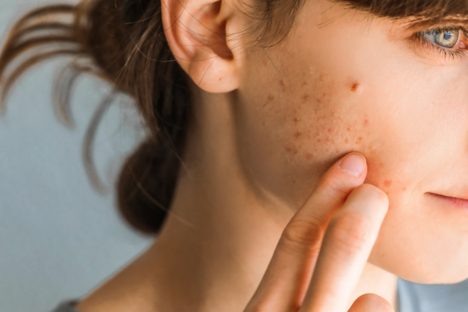 Acne: interessa 1 persona su 5 nel mondo, con una prevalenza del 28,3% tra i giovani