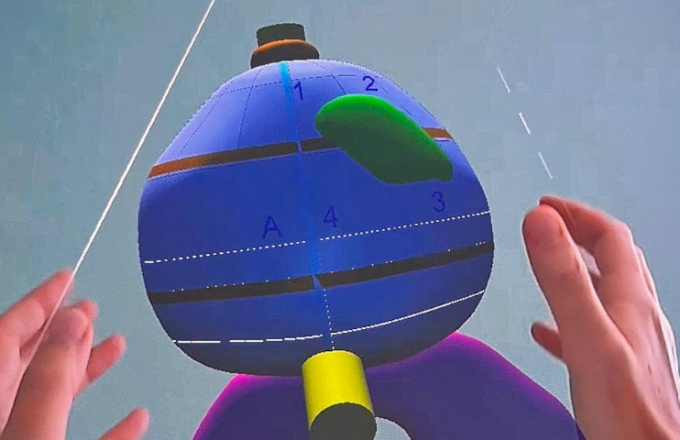 AI e Realtà aumentata: alleati preziosi nella diagnosi di tumore alla prostata. Studio pioneristico al Mauriziano di Torino