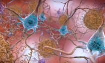 Alzheimer, a Torino scoperto un nuovo gene che ne causa la malattia