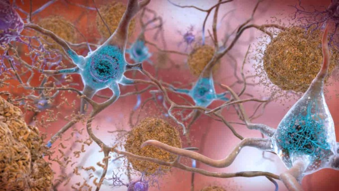 Alzheimer, a Torino scoperto un nuovo gene che ne causa la malattia