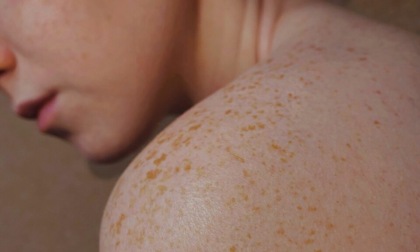 24 maggio: Giornata Europea del melanoma e dei tumori della pelle