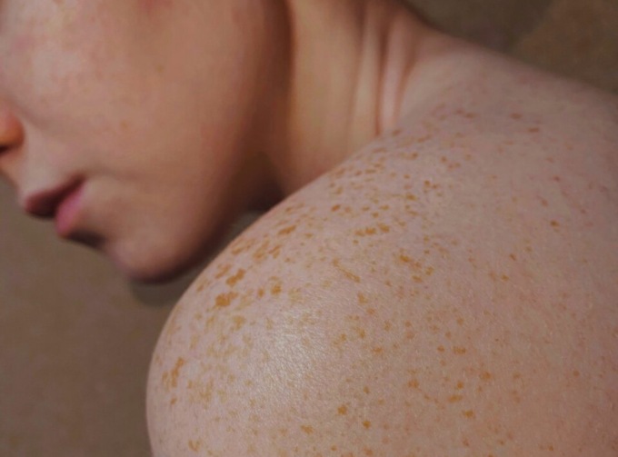 24 maggio: Giornata Europea del melanoma e dei tumori della pelle