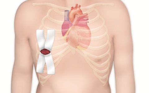 Mixoma atriale: 37enne operata per l’asportazione del tumore cardiaco benigno con un intervento complesso al Maria Pia Hospital