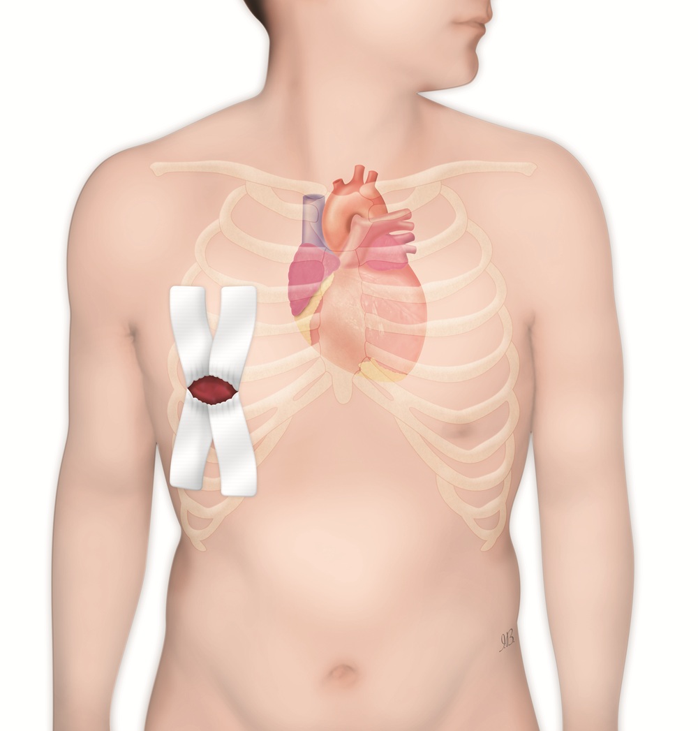 Mixoma atriale: 37enne operata per l’asportazione del tumore cardiaco benigno con un intervento complesso al Maria Pia Hospital